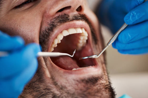 Best Emergency Wisdom Teeth Removal in Whitg, IN